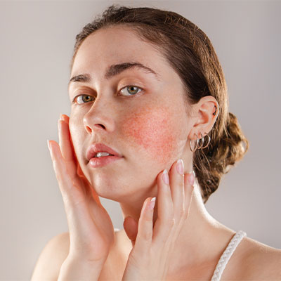 Young woman with rosacea on her cheek.